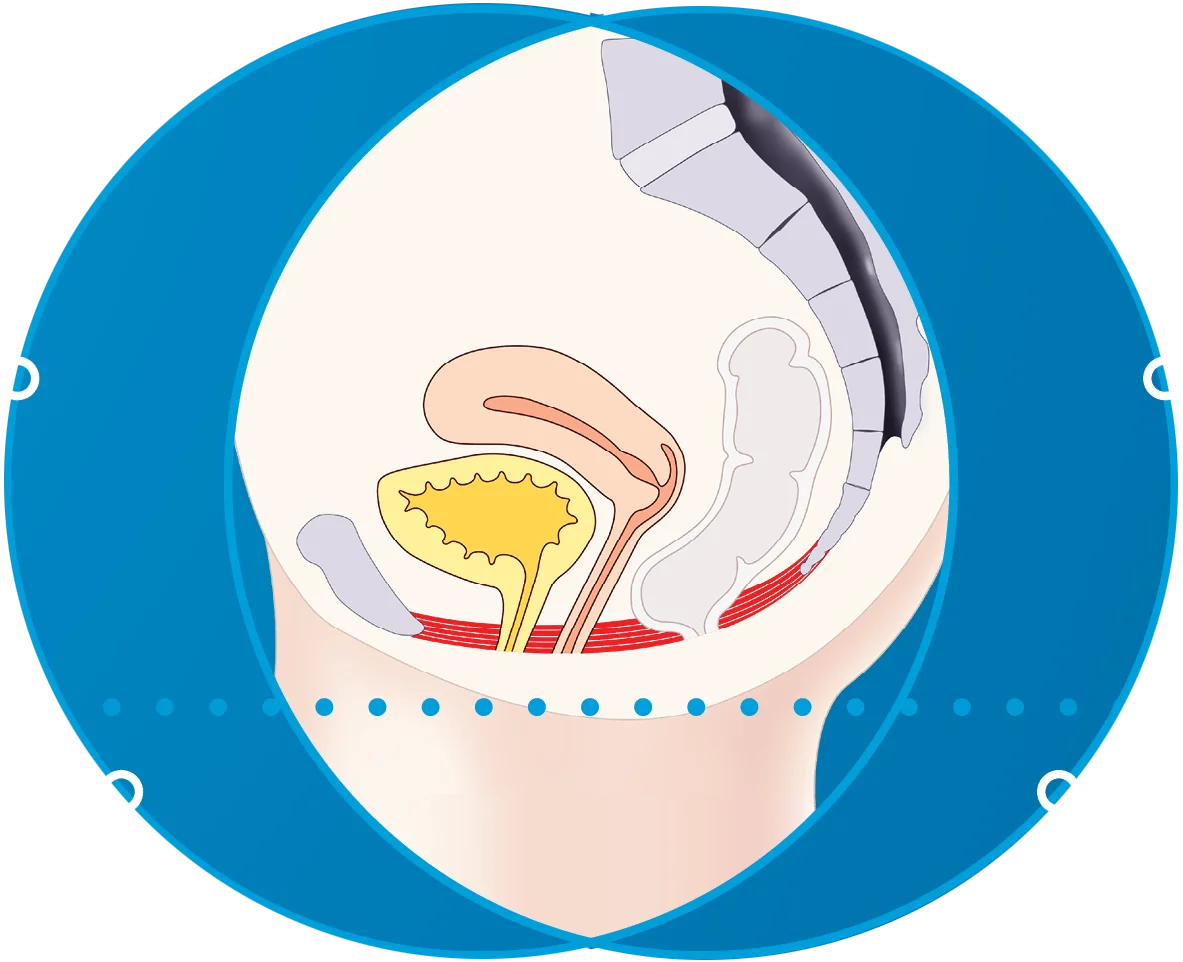 Diagram of the pelvic floor during treatment for EMfemme 360 feminine health treatment in London